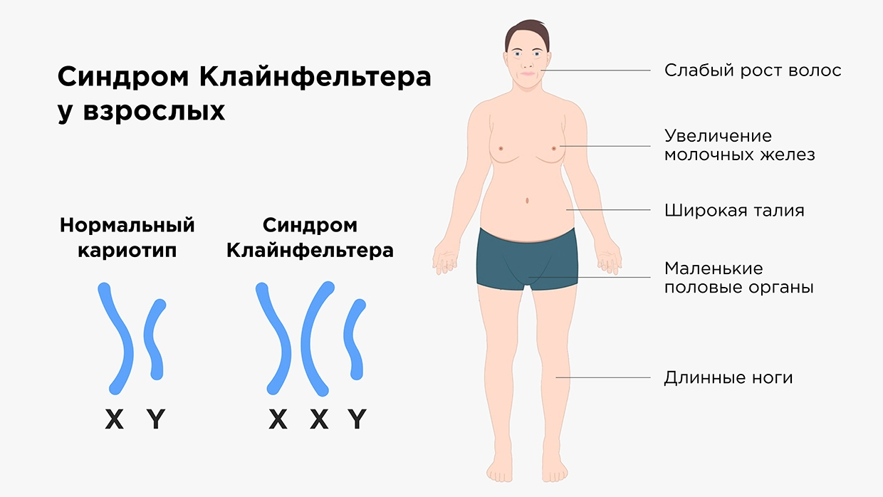 Нарушения формирования пола у детей